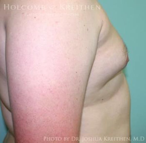 Gynecomastia Before & After Gallery - Patient 6276561 - Image 3