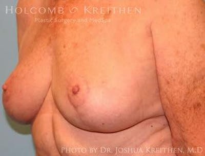 Breast Lift Before & After Gallery - Patient 6276562 - Image 4