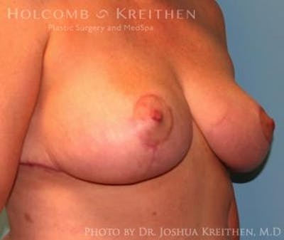Breast Reduction Before & After Gallery - Patient 6276563 - Image 4