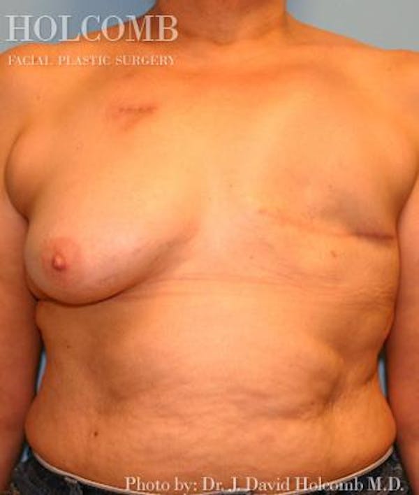 Breast Reconstruction Before & After Gallery - Patient 6276566 - Image 1