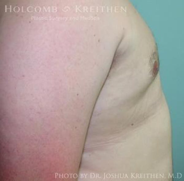 Gynecomastia Before & After Gallery - Patient 6276561 - Image 4