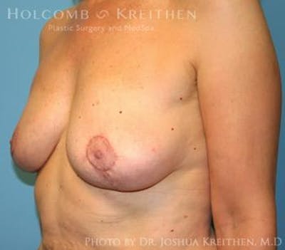 Breast Revision Before & After Gallery - Patient 6276564 - Image 4