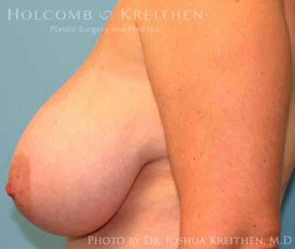 Breast Reduction Before & After Gallery - Patient 6276563 - Image 5