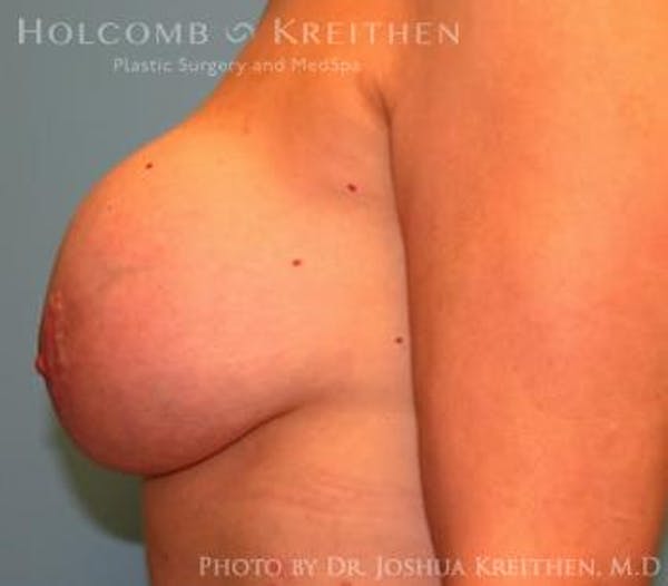 Breast Revision Before & After Gallery - Patient 6276564 - Image 5