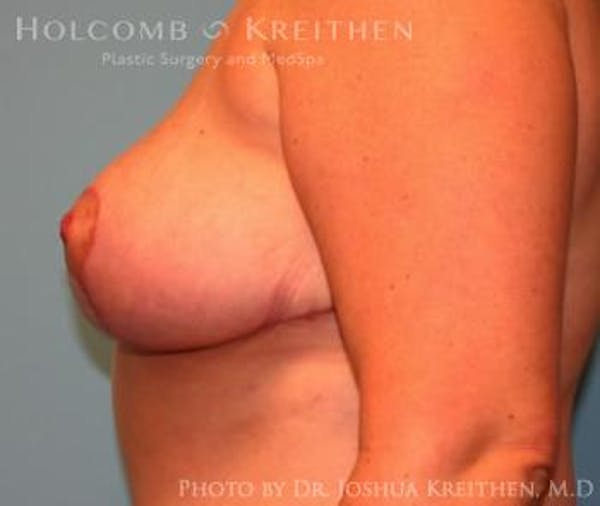 Breast Reduction Before & After Gallery - Patient 6276563 - Image 6