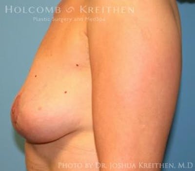 Breast Revision Before & After Gallery - Patient 6276564 - Image 6