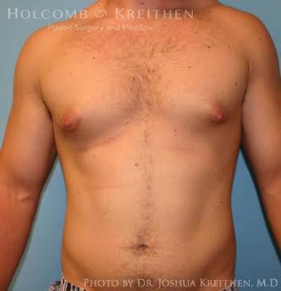Gynecomastia Before & After Gallery - Patient 6276565 - Image 1