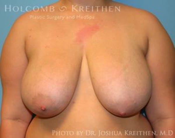 Breast Lift Before & After Gallery - Patient 6276570 - Image 1