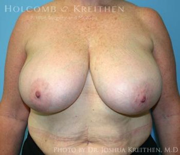 Breast Reduction Before & After Gallery - Patient 6276572 - Image 1