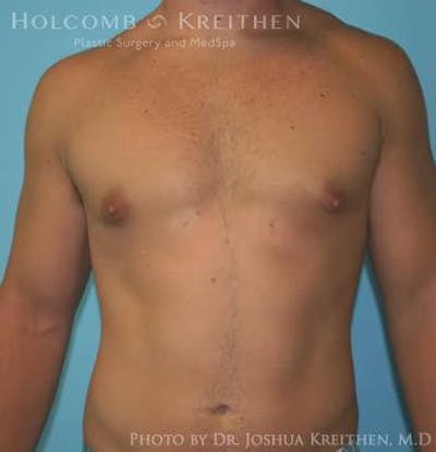 Gynecomastia Before & After Gallery - Patient 6276565 - Image 2
