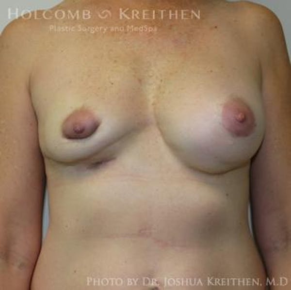 Breast Revision Before & After Gallery - Patient 6276571 - Image 1