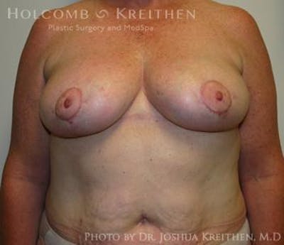 Breast Reduction Before & After Gallery - Patient 6276572 - Image 2