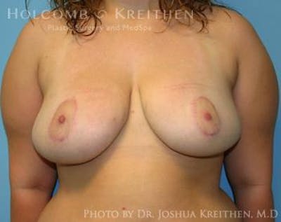 Breast Lift Before & After Gallery - Patient 6276570 - Image 2