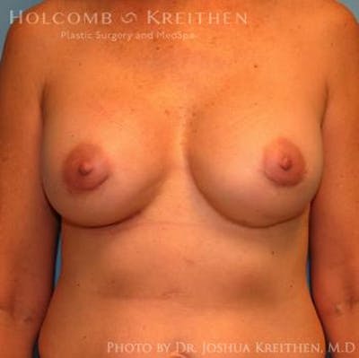 Breast Revision Before & After Gallery - Patient 6276571 - Image 2