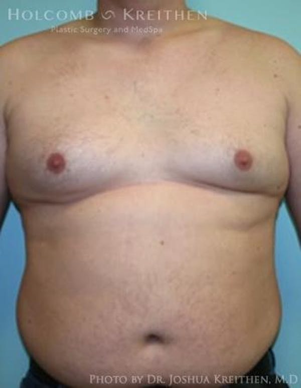 Gynecomastia Before & After Gallery - Patient 6276569 - Image 1