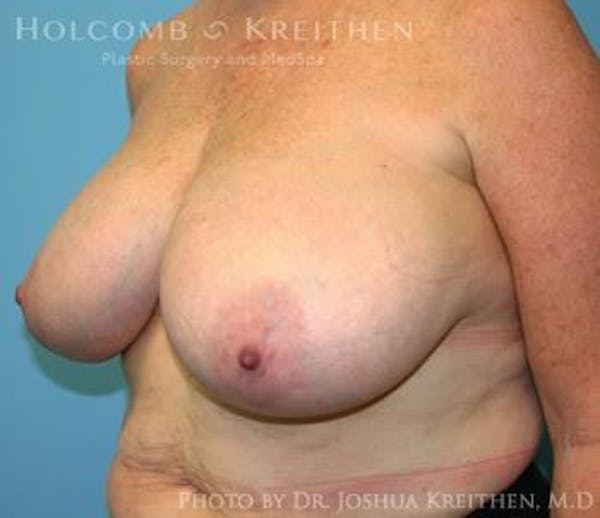 Breast Reduction Before & After Gallery - Patient 6276572 - Image 3