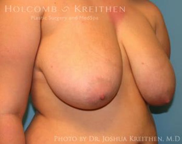 Breast Lift Before & After Gallery - Patient 6276570 - Image 3