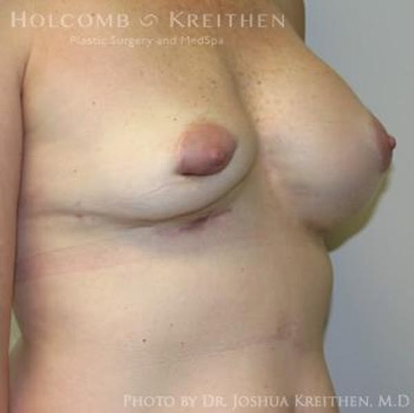 Breast Revision Before & After Gallery - Patient 6276571 - Image 3