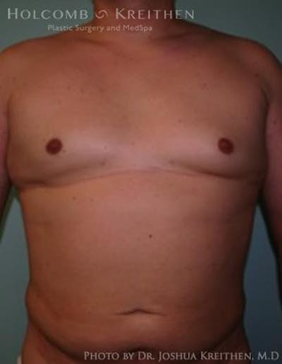 Gynecomastia Before & After Gallery - Patient 6276569 - Image 2
