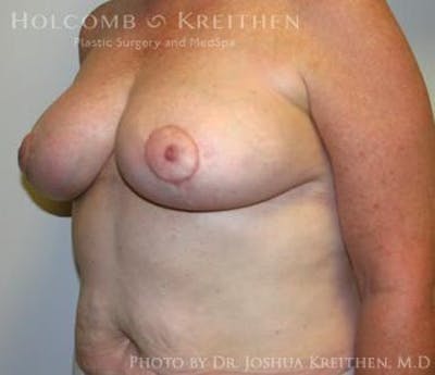 Breast Reduction Gallery - Patient 6276572 - Image 4