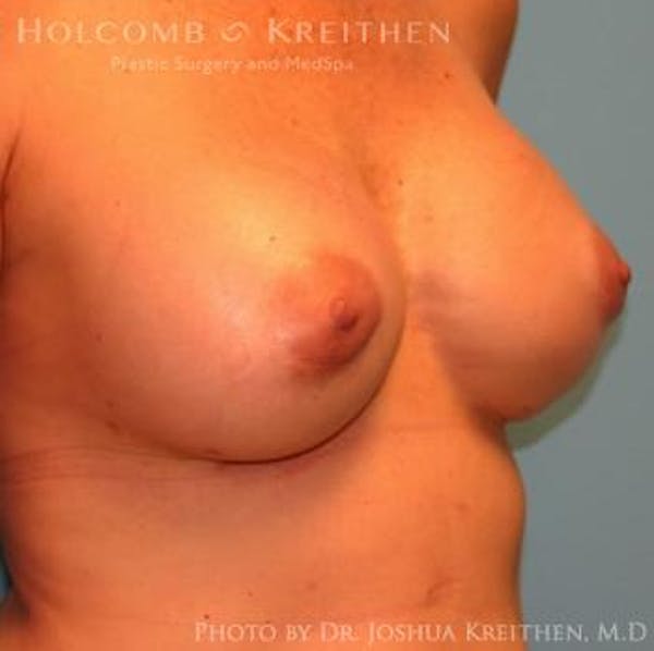 Breast Revision Before & After Gallery - Patient 6276571 - Image 4