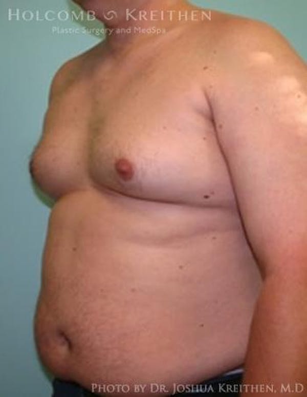 Gynecomastia Before & After Gallery - Patient 6276569 - Image 3