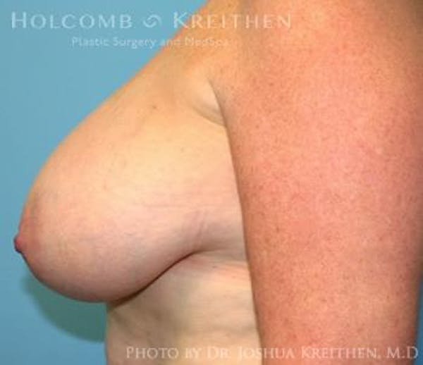 Breast Reduction Before & After Gallery - Patient 6276572 - Image 5