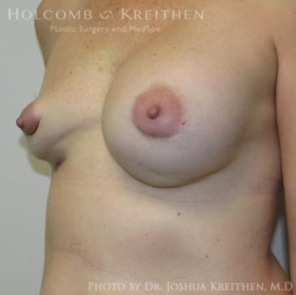 Breast Revision Before & After Gallery - Patient 6276571 - Image 5