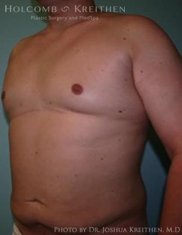 Gynecomastia Before & After Gallery - Patient 6276569 - Image 4