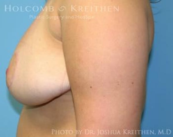 Breast Lift Before & After Gallery - Patient 6276570 - Image 6