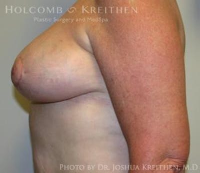 Breast Reduction Before & After Gallery - Patient 6276572 - Image 6
