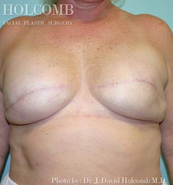 Breast Reconstruction Before & After Gallery - Patient 6276573 - Image 2