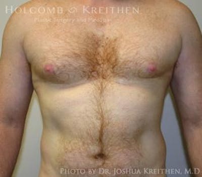 Gynecomastia Before & After Gallery - Patient 6276577 - Image 1