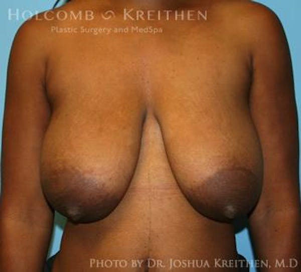Breast Lift Before & After Gallery - Patient 6276578 - Image 1