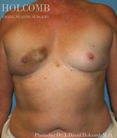Breast Reconstruction Before & After Gallery - Patient 6276575 - Image 1