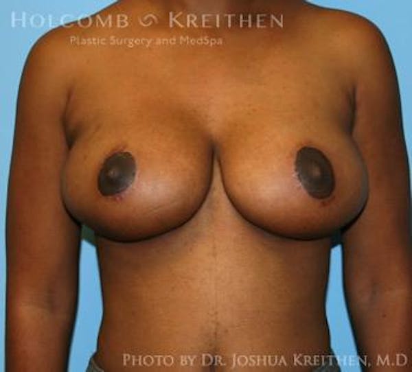 Breast Lift Before & After Gallery - Patient 6276578 - Image 2
