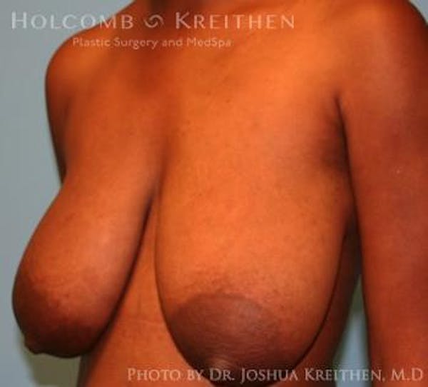 Breast Lift Before & After Gallery - Patient 6276578 - Image 3