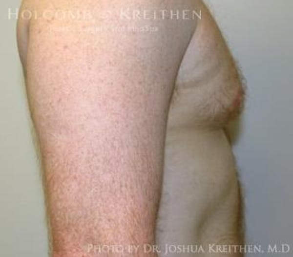 Gynecomastia Before & After Gallery - Patient 6276577 - Image 3