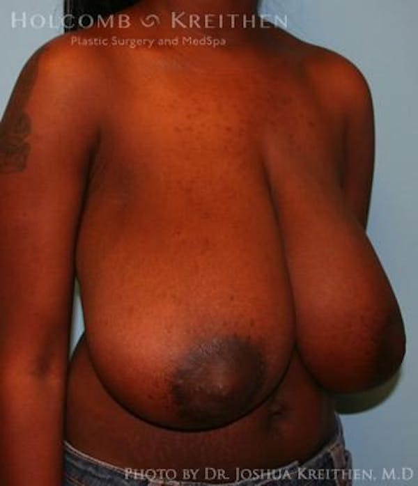 Breast Reduction Gallery - Patient 6276579 - Image 3
