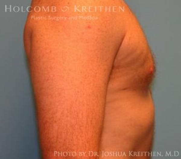 Gynecomastia Before & After Gallery - Patient 6276577 - Image 4