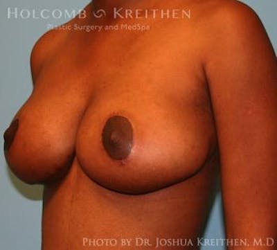 Breast Lift Before & After Gallery - Patient 6276578 - Image 4