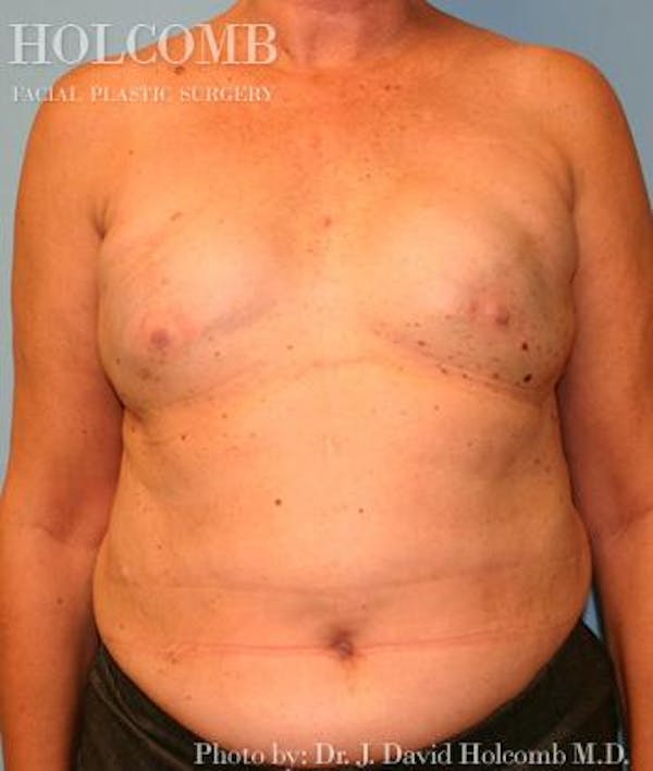 Breast Reconstruction Before & After Gallery - Patient 6276576 - Image 1