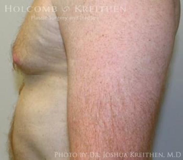 Gynecomastia Before & After Gallery - Patient 6276577 - Image 5