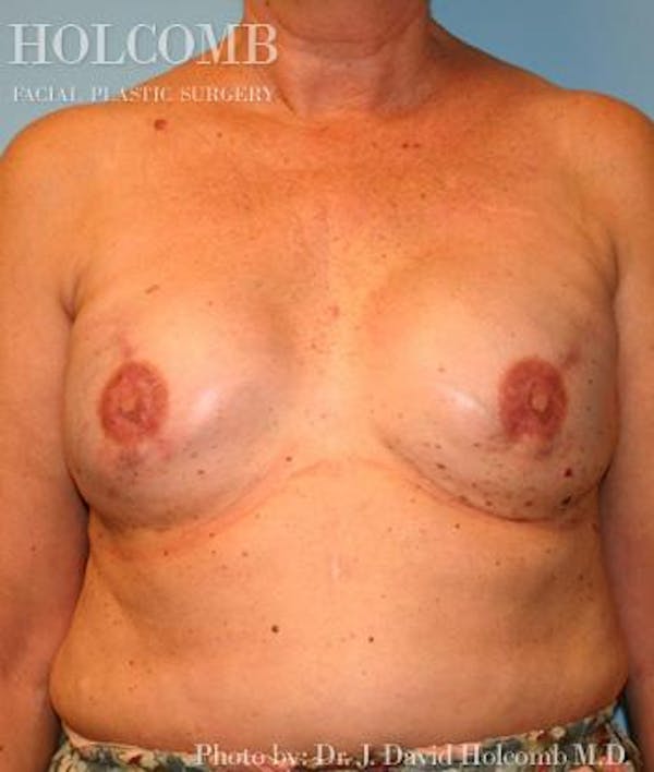 Breast Reconstruction Before & After Gallery - Patient 6276576 - Image 2