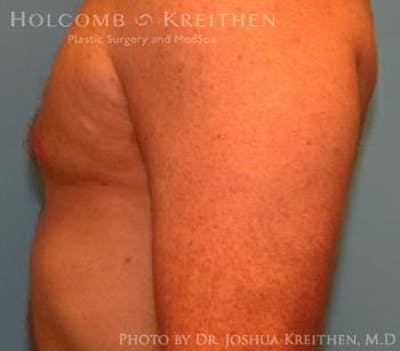 Gynecomastia Before & After Gallery - Patient 6276577 - Image 6