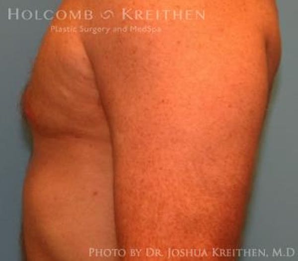 Gynecomastia Before & After Gallery - Patient 6276577 - Image 6