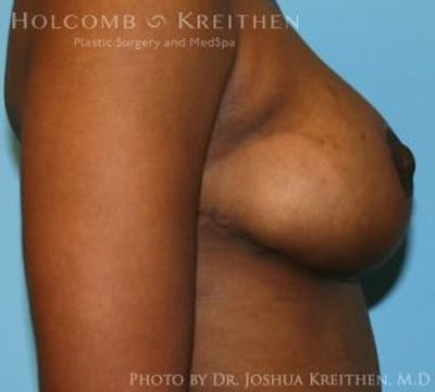 Breast Lift Before & After Gallery - Patient 6276578 - Image 6