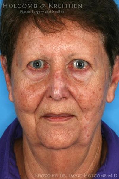 Brow Lift Before & After Gallery - Patient 6279188 - Image 1