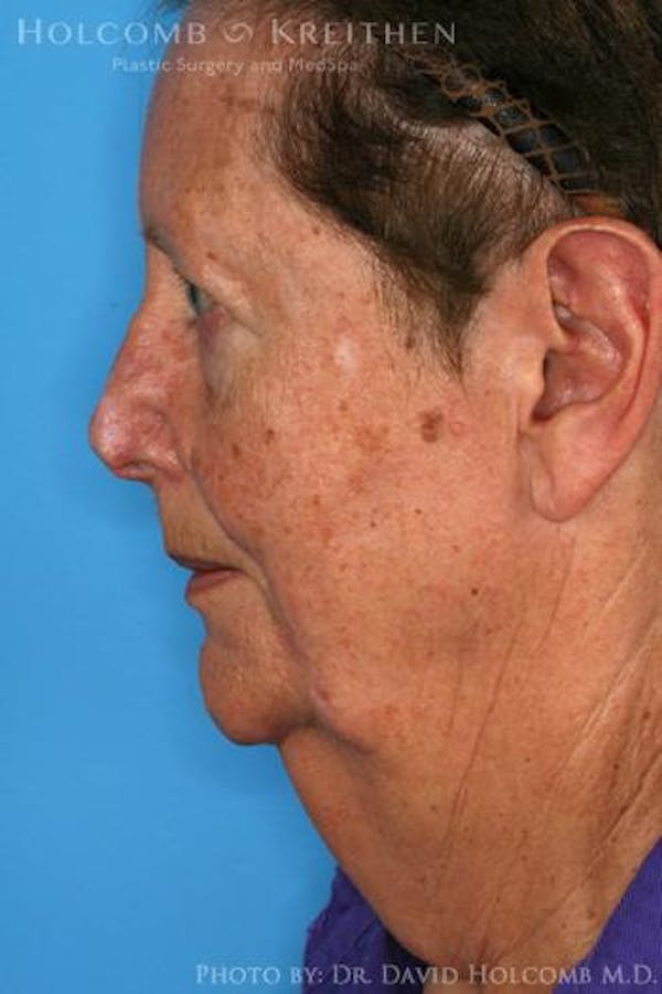 Brow Lift Before & After Gallery - Patient 6279188 - Image 5