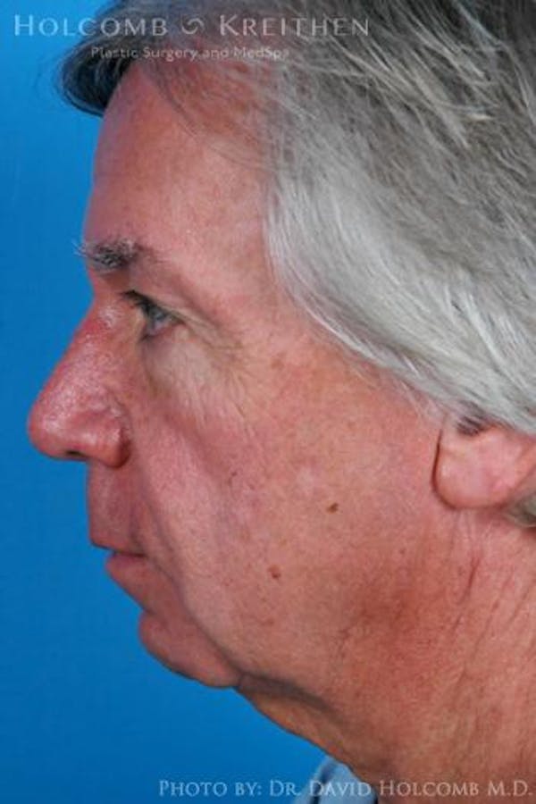 Cheek Implant Before & After Gallery - Patient 6279190 - Image 5
